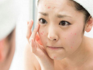 Có nên nặn mụn không? Bị mụn nên làm gì?
