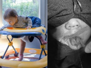 Sức khỏe - Bé 10 tháng tuổi đứt lưỡi vì tai nạn xe tập đi, BS chia sẻ sự thật về xe này