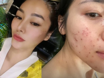 Linh Chi, Hòa Minzy mặt chi chít tổn thương, cắn răng chịu đau vì một làn da láng mịn