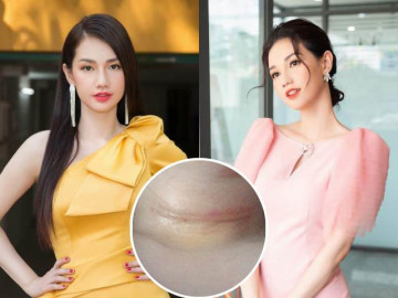 Hình ảnh mới nhất của MC Quỳnh Chi sau ca phẫu thuật vì tế bào ung thư xâm lấn