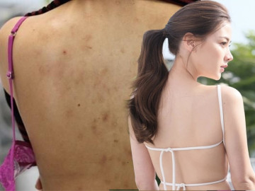 Dáng đẹp nhưng lưng mụn thâm chi chít, chị em chữa liền bây giờ vẫn kịp diện bikini
