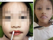 Sức khỏe - Bé gái 5 tuổi được đưa đi phun xăm môi​​​​​​​: Bác sĩ cảnh báo "Có thể gây hại cho trẻ"