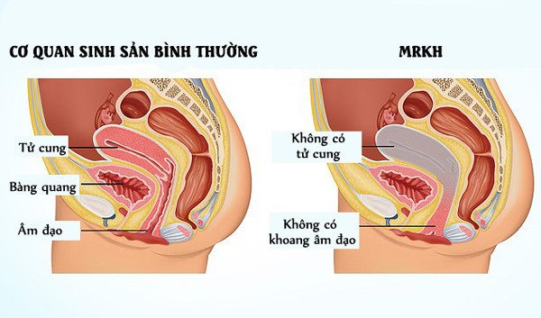 Người phụ nữ có thể không bao giờ quan hệ vì mắc bệnh hiếm, buộc phải tự tạo âm đạo - 5