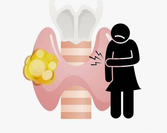 Không phải dưa muối, 4 thứ này mới là nguyên nhân gây ra ung thư tuyến giáp - 2