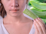 Làm đẹp - Tuyển tập trị mụn bằng nha đam “bai bai” làn da khuyết điểm