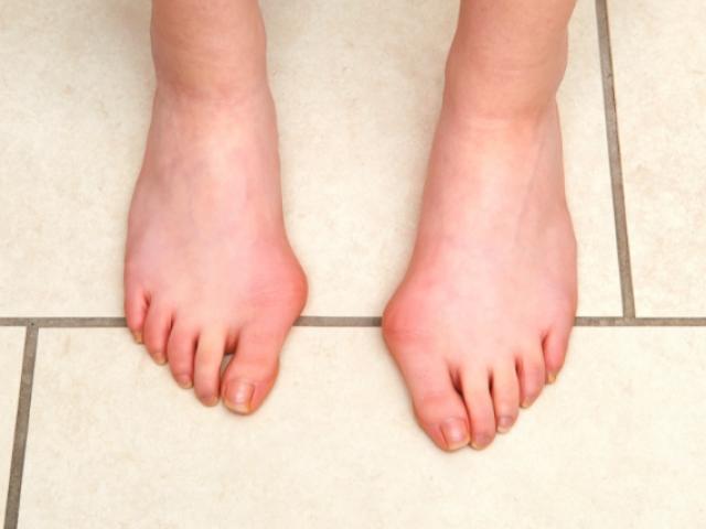 Bàn chân có những dấu hiệu này cẩn thận mắc tiểu đường hoặc bệnh tim