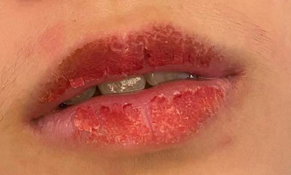 What is a biological lip implant?  What experts say about the method of removing dark lips - 8