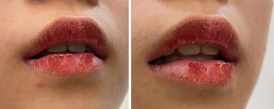 What is a biological lip implant?  What experts say about the method of removing dark lips - 9