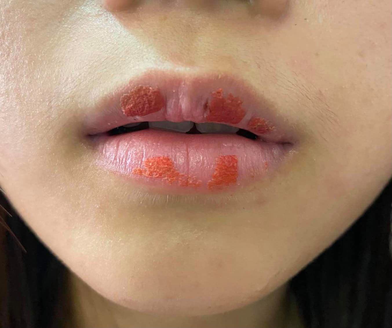 What is a biological lip implant?  What experts say about the method of removing dark lips - 11