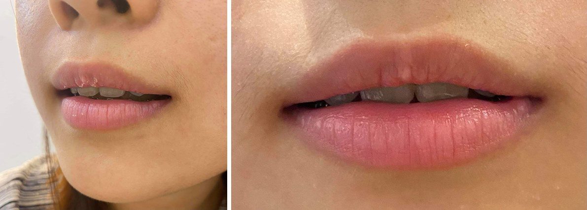 What is a biological lip implant?  What experts say about the method of removing dark lips - 12