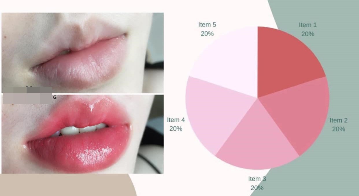 What is a biological lip implant?  What experts say about the method of removing dark lips - 14