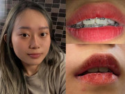 Làm đẹp - Hồi hộp xem review cấy hồng môi khử thâm, chuyên gia nói gì về phương pháp này?