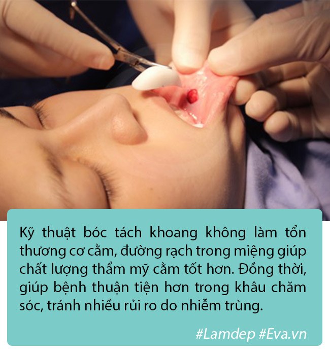 Độn cằm là phương pháp PTTM rất đơn giản nhưng tại sao vẫn có nhiều ca biến chứng? - 1