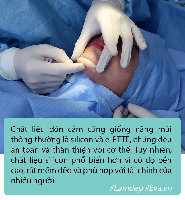 Độn cằm là phương pháp PTTM rất đơn giản nhưng tại sao vẫn có nhiều ca biến chứng? - 3