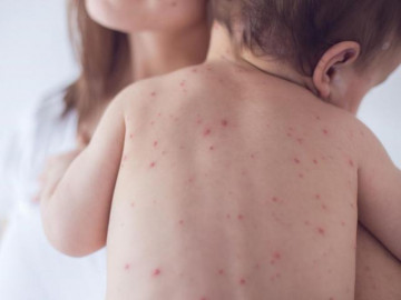 Các chuyên gia lý giải lý do vì sao cần thiết chủng ngừa sớm Thủy đậu cho trẻ nhỏ