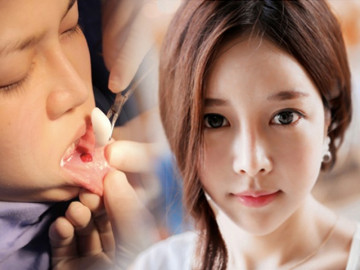 Độn cằm là phương pháp PTTM rất đơn giản nhưng tại sao vẫn có nhiều ca biến chứng?