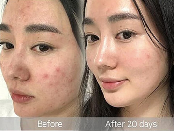 Hiểu về thành phần dưỡng trắng, trị thâm để không bị dắt mũi khi mua mỹ phẩm
