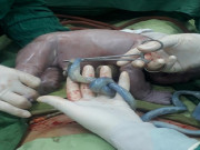 Bà bầu - Mẹ Hải Dương 22 tuổi nhập viện sinh con, bác sĩ "toát mồ hôi" cấp cứu khi nhìn nước ối