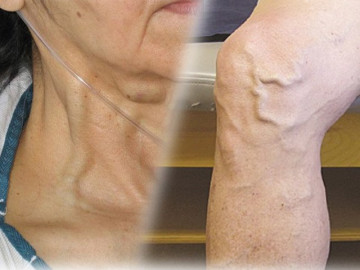 Nổi gân xanh bất thường ở 3 vùng này có thể cảnh báo bệnh tim hoặc có u trong người