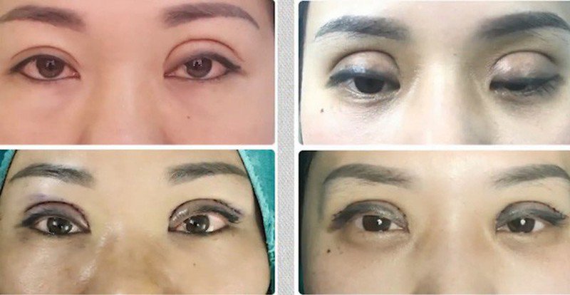 Sởn gai ốc trước hình ảnh những ca nhấn, cắt mí mắt thất bại - 7