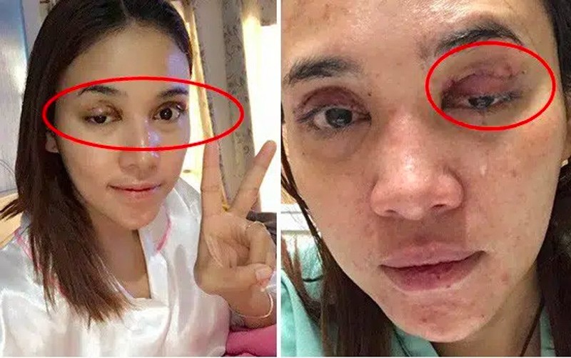 Sởn gai ốc trước hình ảnh những ca nhấn, cắt mí mắt thất bại - 8