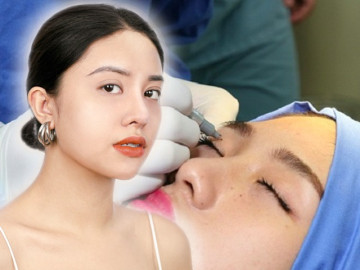 Sởn gai ốc trước hình ảnh những ca nhấn, cắt mí mắt thất bại 