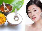 Làm đẹp - 10 Cách trị mụn viêm sưng đỏ tại nhà an toàn hiệu quả