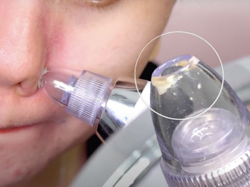 Máy hút mụn đầu đen lợi hại thật nhưng đây có phải cách trị mụn bạn nên dùng?