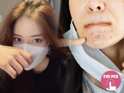 Làm đẹp - Eva Pick: Mụn mọc thành chùm khi đeo khẩu trang, chắc hẳn nàng đã mắc 4 sai lầm sau
