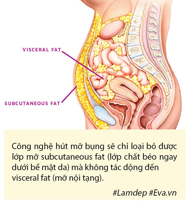 Hút mỡ tạo hình thành bụng có nguy hiểm không? - 1