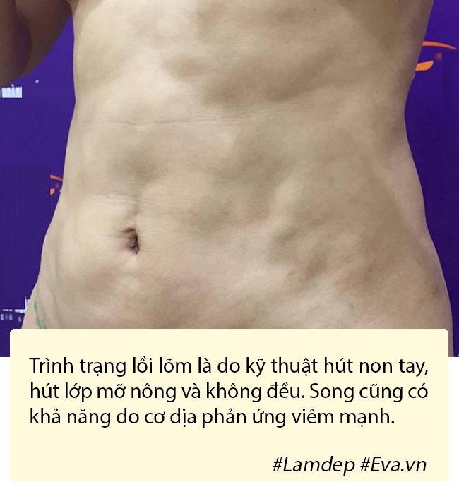 Hút mỡ tạo hình thành bụng có nguy hiểm không? - 5