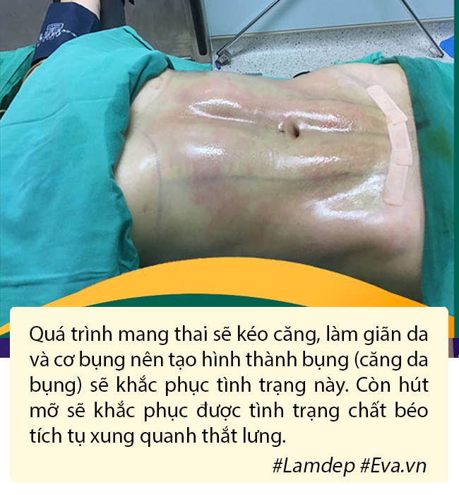 Hút mỡ tạo hình thành bụng có nguy hiểm không? - 6
