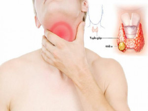 Ai bị mệt mỏi, tim đập nhanh vì bướu tuyến giáp - Thử ngay thảo dược này