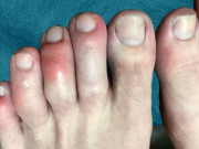 Sức khỏe - 10 dấu hiệu ở bàn chân tưởng bệnh nhẹ nhưng có thể là biểu hiện ung thư, thậm chí COVID-19