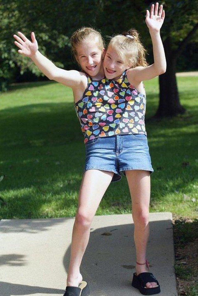 Cặp sinh đôi dính liền amp;#34;một thể xác, 2 linh hồnamp;#34;, mơ ước tìm được 2 chàng trai để yêu - 2