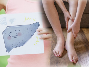 6 dấu hiệu gan đầy độc tố, không cẩn thận dễ xơ như mướp hay thậm chí phải thay gan