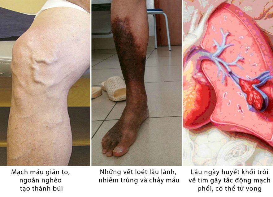Bệnh suy giãn tĩnh mạch chân là gì? có nguy hiểm không? - 3
