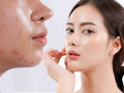 Làm đẹp - Cách chọn kem chống nắng cho da dầu mụn để cuối ngày da vẫn khô ráo