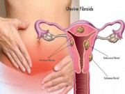 Nhờ thảo dược này, nhiều chị em đã thu nhỏ được kích thước u xơ tử cung