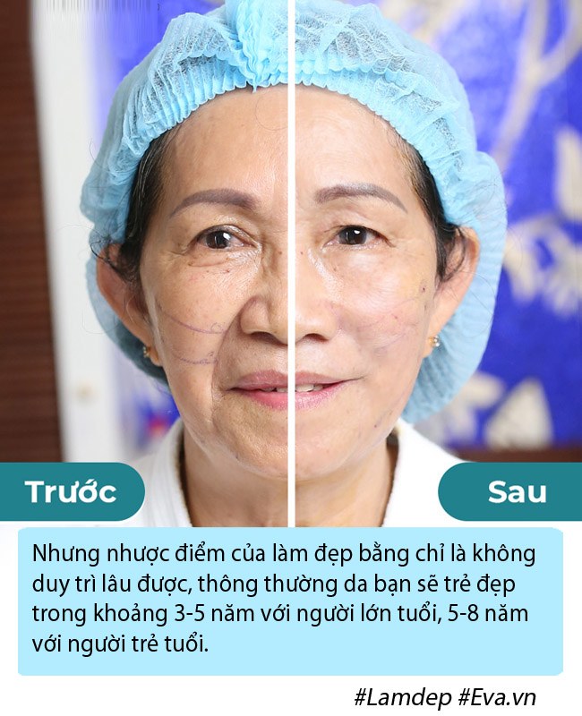 Bạn có đang nhầm lẫn về phương pháp căng chỉ collagen trẻ hóa da mặt? - 3