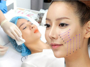 Bạn có đang nhầm lẫn về phương pháp căng chỉ collagen trẻ hóa da mặt?