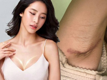 Đi nâng ngực, gái xinh khóc thét vì đường rạch nách xấu, sẹo dài nửa bàn tay