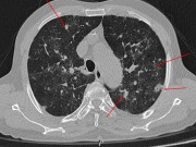 Sức khỏe - Người đàn ông Phú Thọ có phổi đông đặc sau 20 ngày khỏi COVID-19