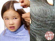 Làm đẹp - Rùng mình cách các mẹ trị chấy tóc cho con: duỗi ép không xi nhê, đặc trị bằng... bột giặt