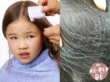 Rùng mình cách các mẹ trị chấy tóc cho con