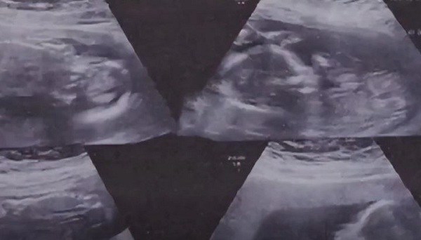 10X mother was pregnant with quadruplets, but 4 babies were born differently - 1
