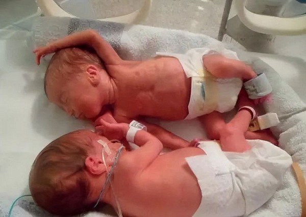10X mother was pregnant with quadruplets, but 4 children were born differently - 2