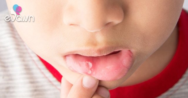 What to do if a child has a cold sore?