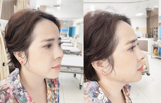 Các phương pháp nâng mũi amp;#34;để đờiamp;#34; của bác sĩ Lê Quý  - 4