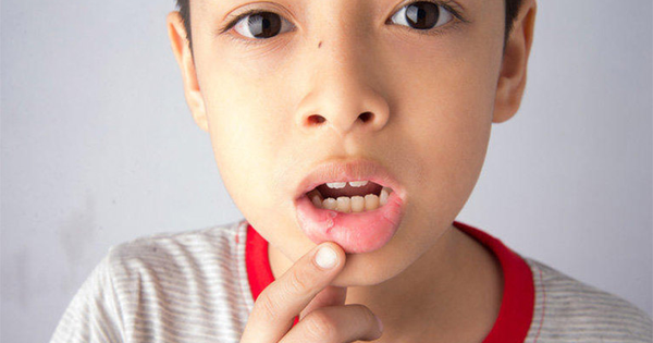 What to do if a child has a cold sore?  - first